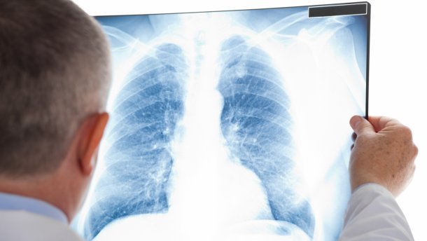 На Прикарпатті зростає кількість хворих на туберкульоз