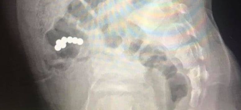 П’ятирічний хлопчик проковтнув сім магнітів – їх видалили хірурги обласної дитячої лікарні (ФОТОФАКТ)