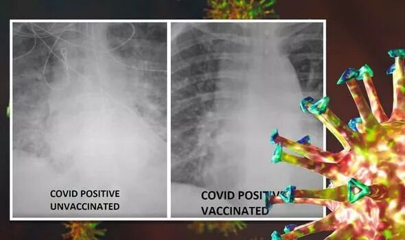 У США медики порівняли легені щепленого і нещепленого COVID-хворих