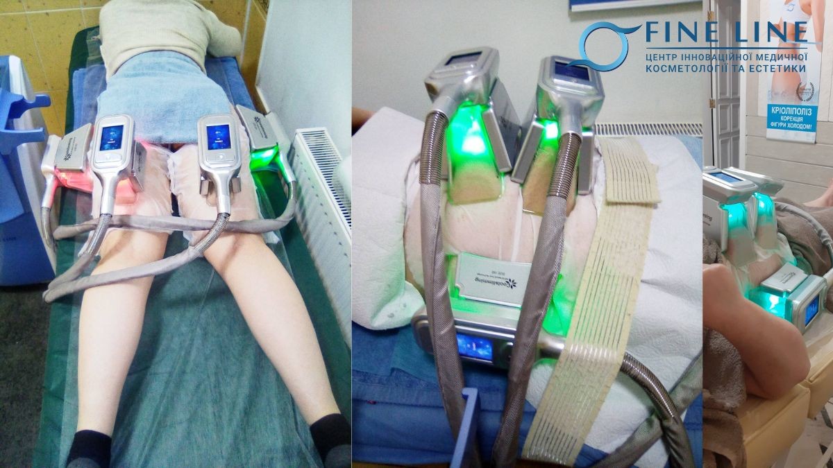 Кріоліполіз у Івано-Франківську: Косметологія FineLine
