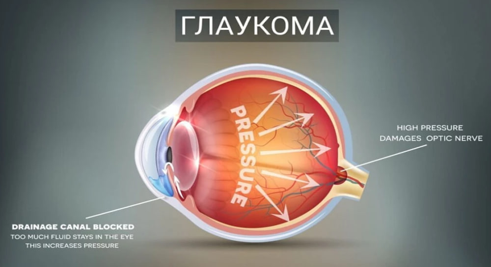 Глаукома: як вчасно виявити та лікувати