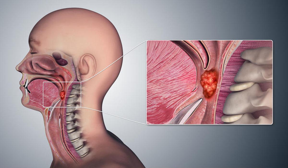 Рак гортані: який має вигляд